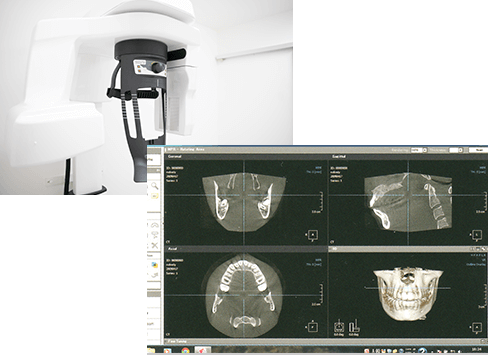 歯科用CT