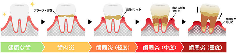 歯周病の進行