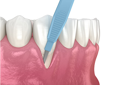 歯周形成外科療法
